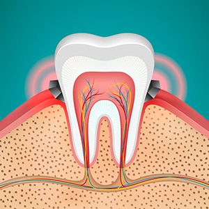 Gingivitis Illustration